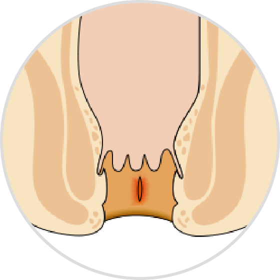 肛裂的主要症状
