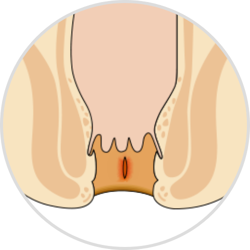 きれ痔（裂肛）